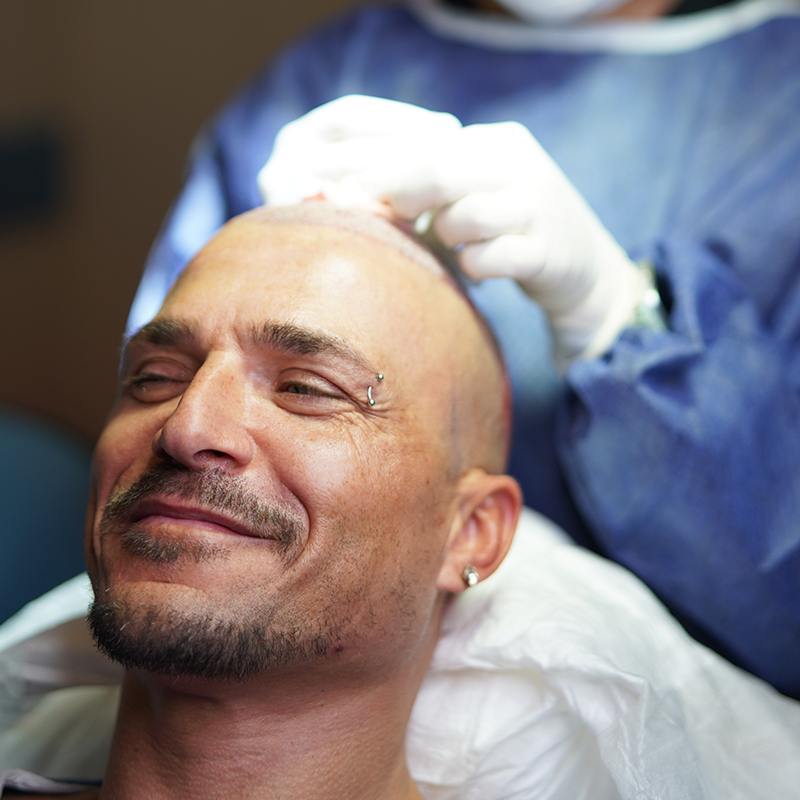 Wissenswertes Über Haartransplantation