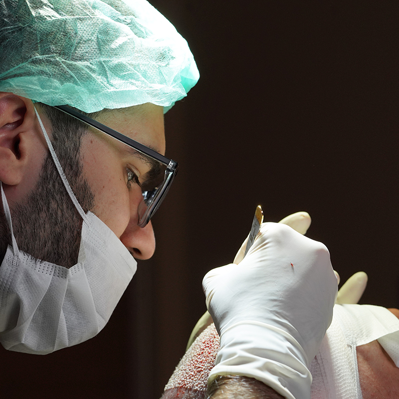 Gründe Für Haarausfall Bei Männern Und Dauerhafte Lösungen