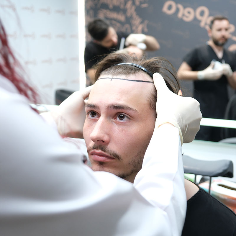 Das Richtige Timing ist Entscheidend: Haarschnitte Nach Einer Haartransplantation