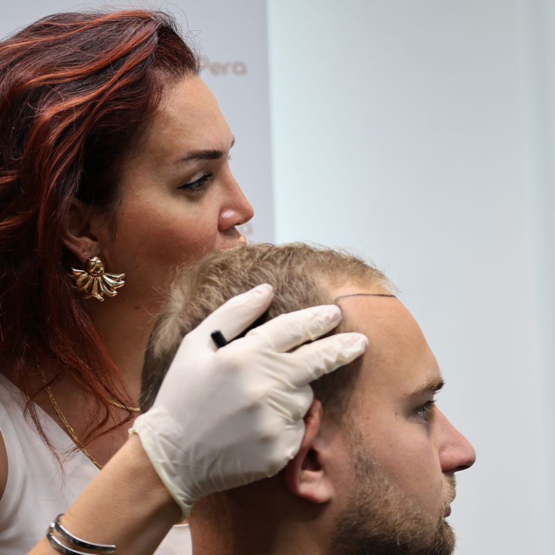 Wann Kann İch Meine Haare Nach Einer Haartransplantation Färben?