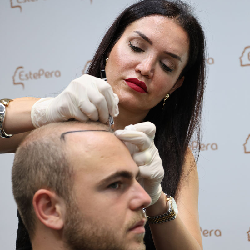 Alopecia Areata Verstehen: Ein Tiefgehender Leitfaden