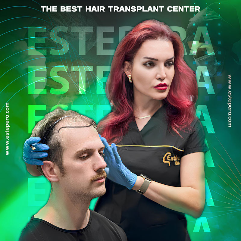 Can I Get 5000 Grafts Hair Transplant in a Single Session?