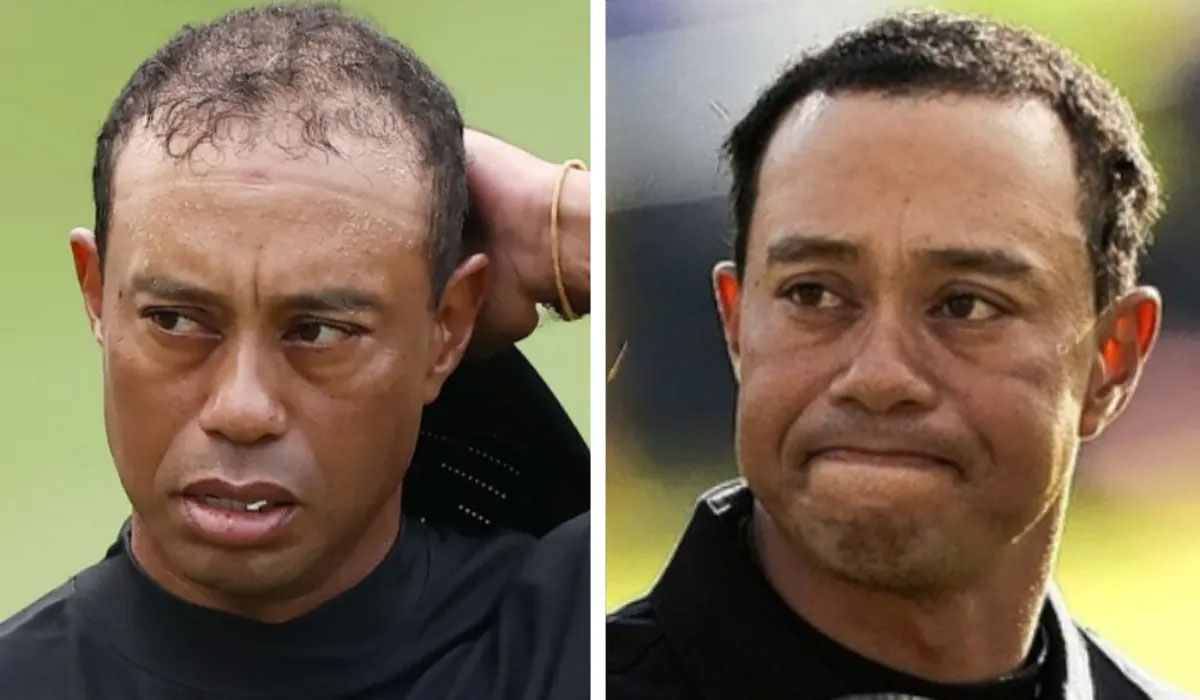 Tiger Woods Hair Transplant 2 Tiger Woods Before After