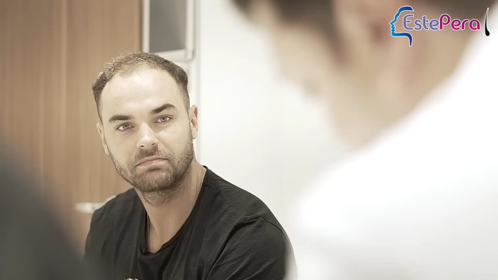 Harry Cooksley’s Hair Transplant Transformation Revealed 2 Harry Cooksley before Hair Transplant