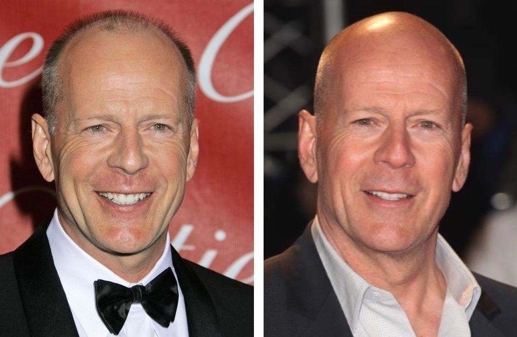 41 Famous Bald Celebrities