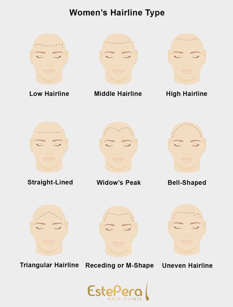 Hairline Types for Men and Woman 1 Hairline Types for Men and Woman