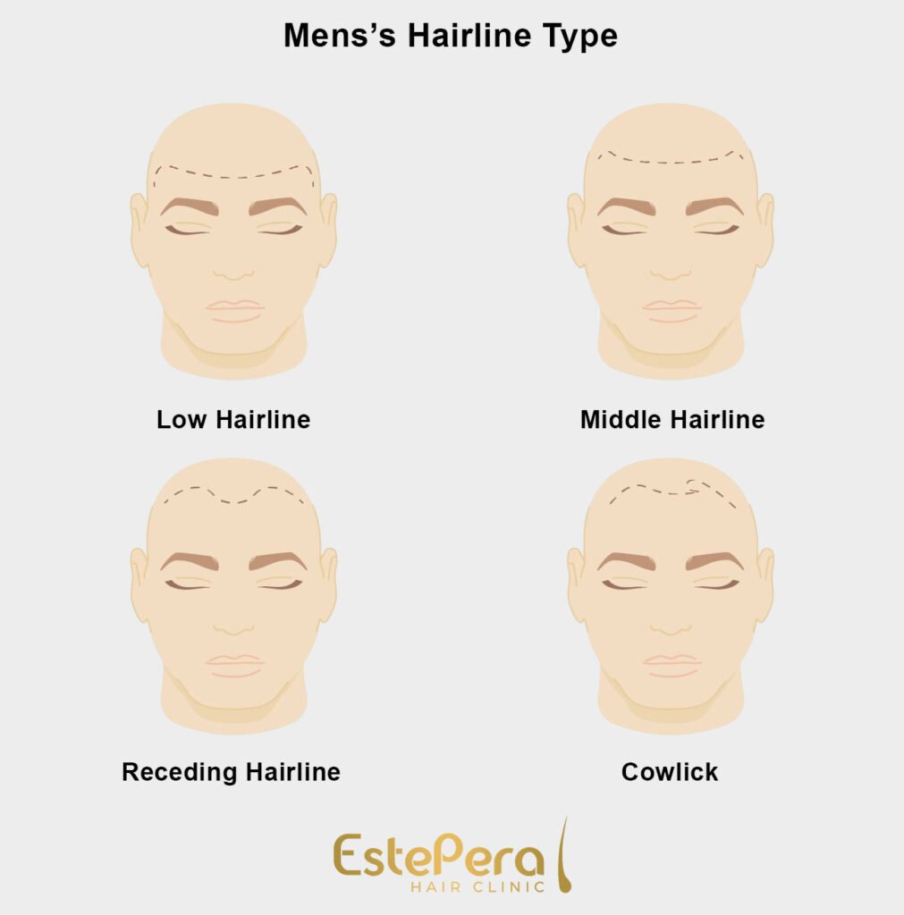 Hairline Types for Men and Woman 2 Hairline Types for Men and Woman