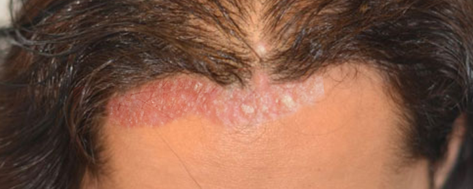 Recurring Scab On Scalp In The Same Spot 1 Seborrheic Dermatitis